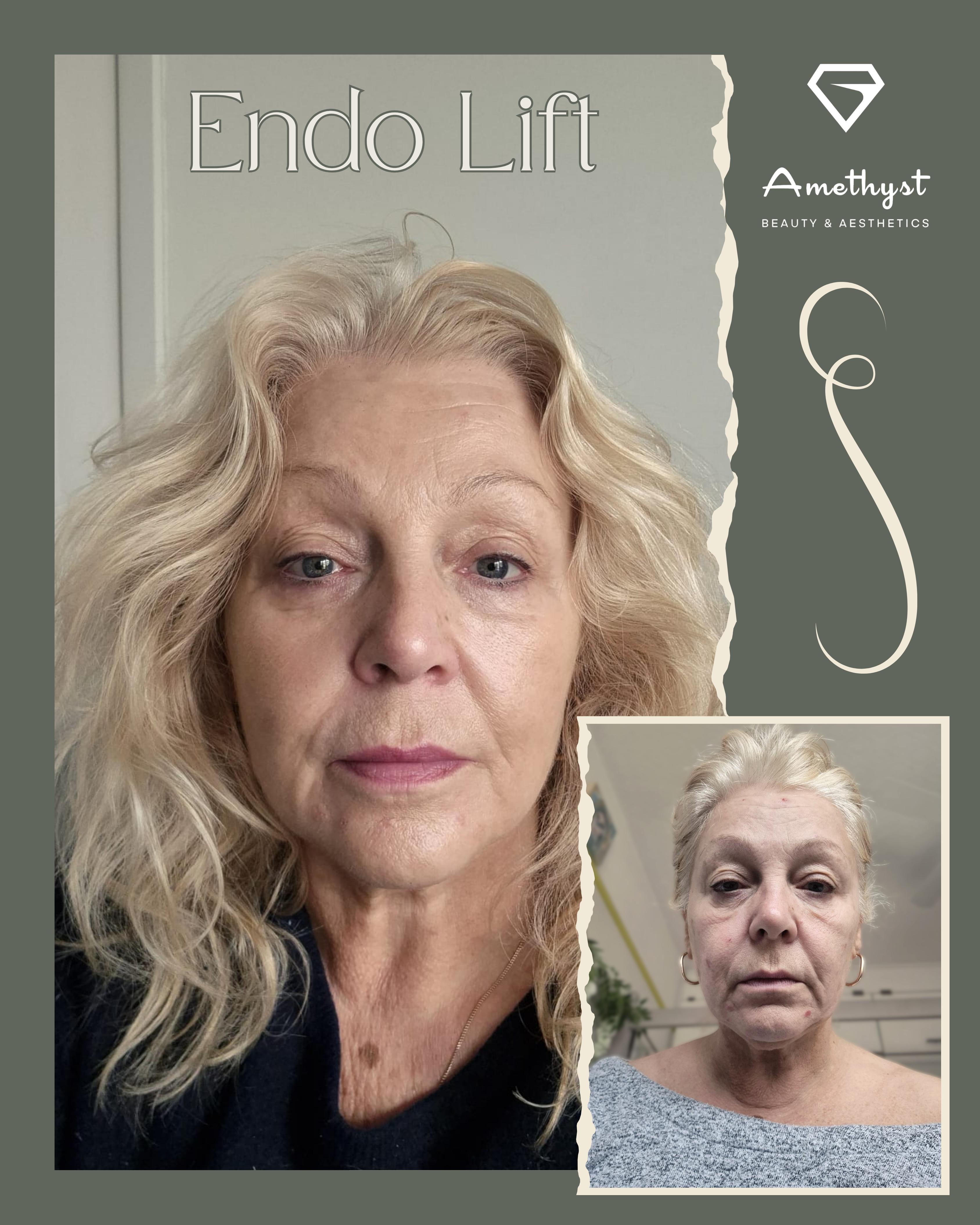 Full Face Transformation