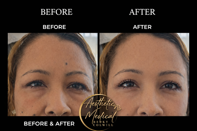 Eye Area Rejuvenation