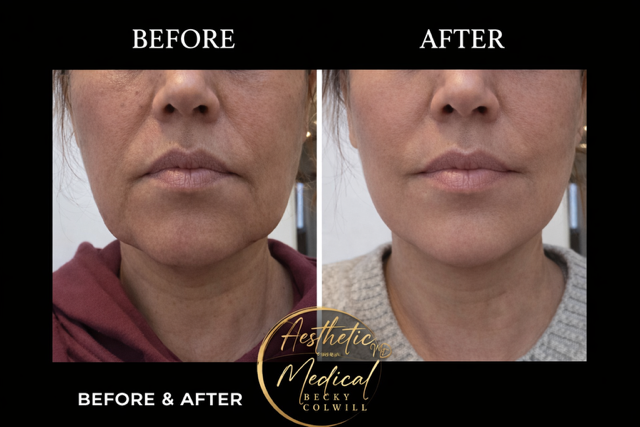 Lower Face & Jowl Tightening