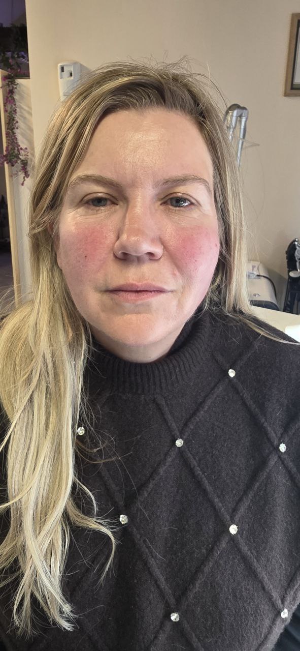 Jawline & Jowl Tightening - After