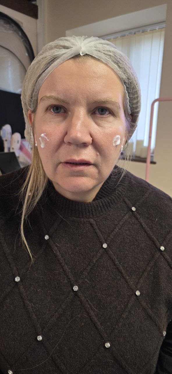 Jawline & Jowl Tightening - Before