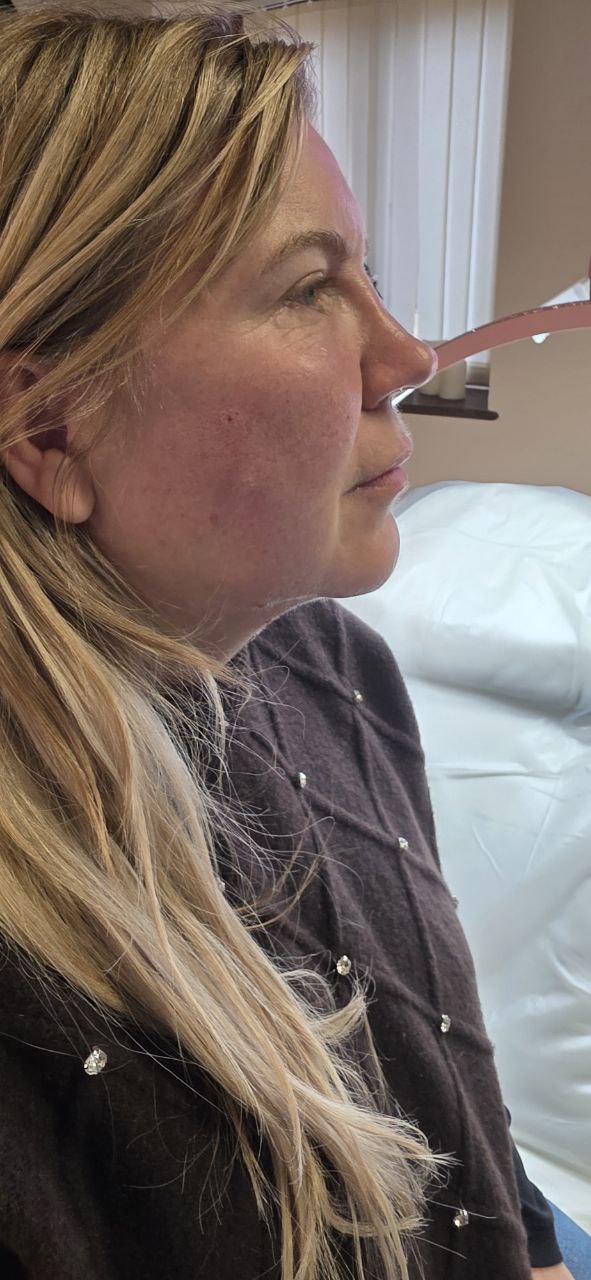 Right Side Profile - After