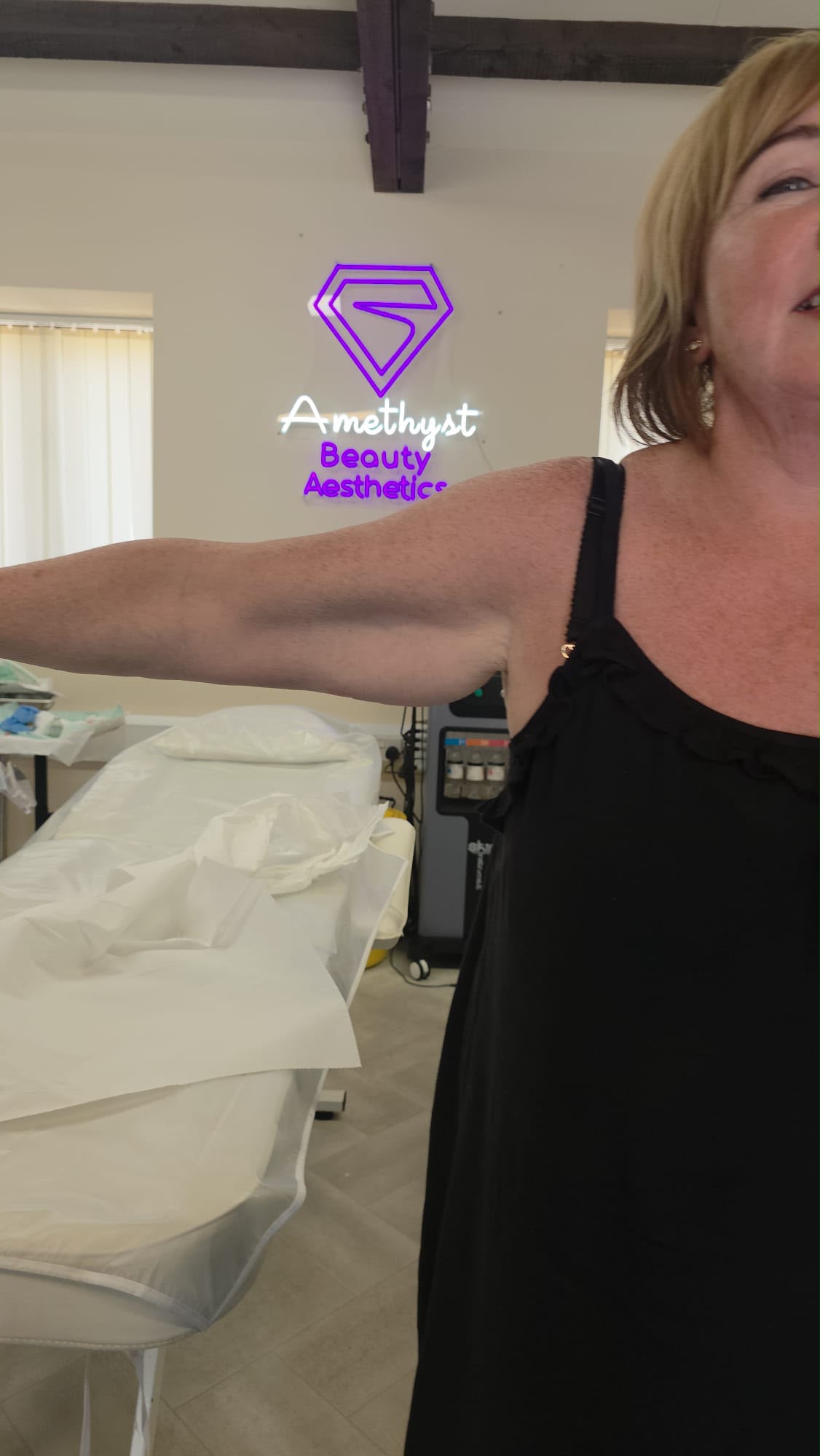 Endolift arm tightening after — firmer, more contoured upper arms