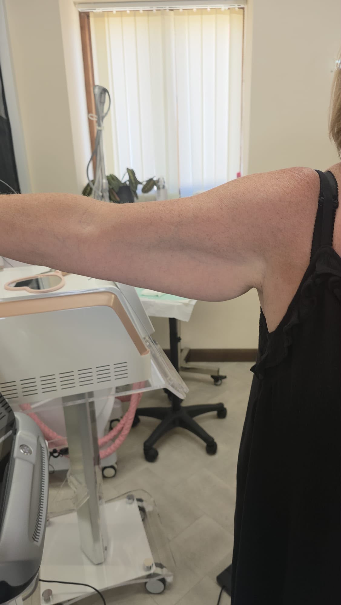Endolift arm tightening before